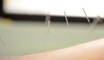 Acupuncture : une solution efficace pour la santé Acupuncture : une solution efficace pour la santé