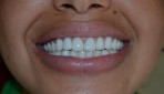 Tout savoir sur la couronne dentaire Tout savoir sur la couronne dentaire